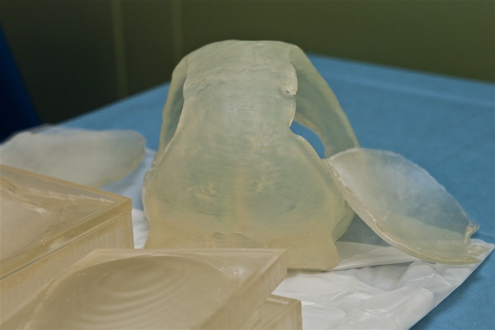 Технология стереолитографического моделирования позволяет воссоздать 3D модель черепа пациента для устранения косметического дефекта вследствие перенесенной черепно-мозговой травмы. На фото стереолитографическая модель, воссозданная по компьютерной 3D модели черепа пациента, которому в другой клинике после перенесенной ЧМТ дренировали обширную двустороннюю гематому и удалили два больших костных лоскута.