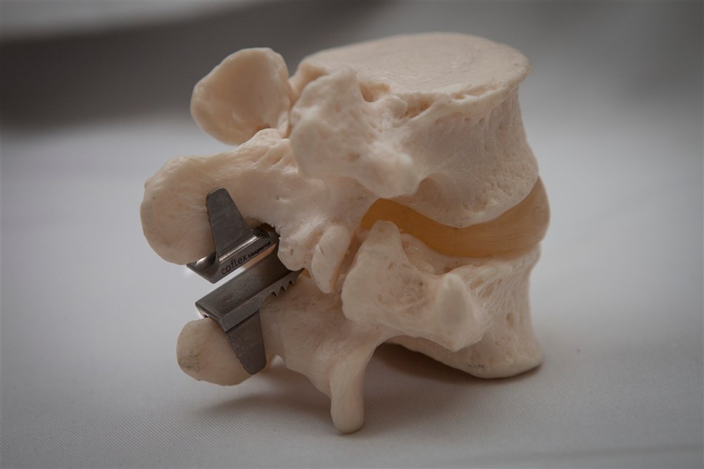 На фото имплант Coflex, установленный между остистыми отростками на макете позвоночника.