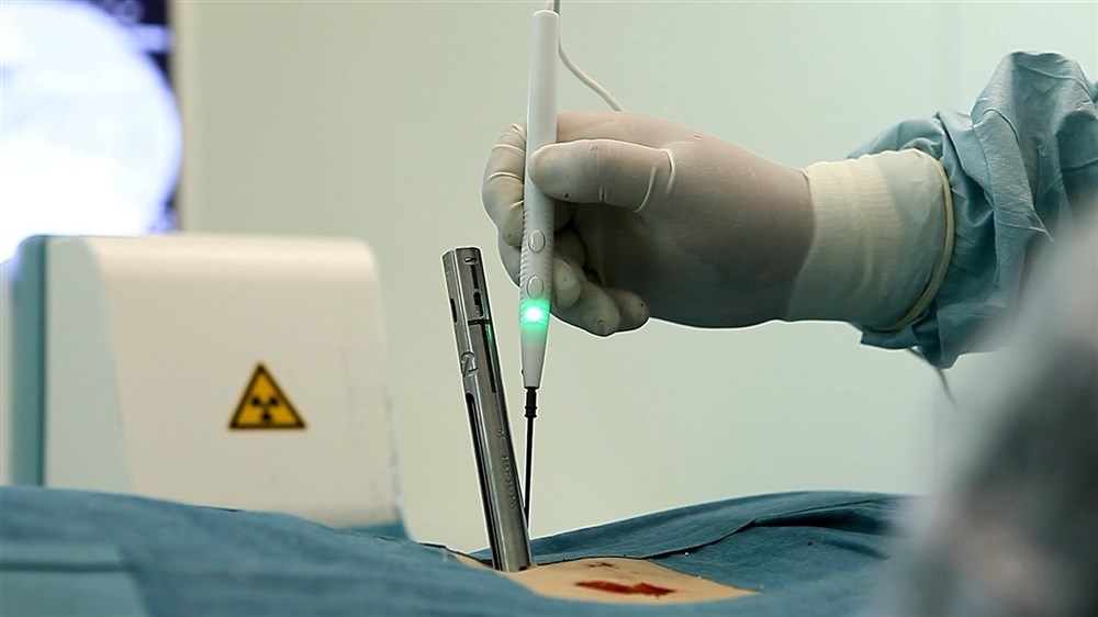 На фото процесс проверки расстояния до нервного корешка в операции по удалению межпозвонковой грыжи с установкой стабилизирующей системы.