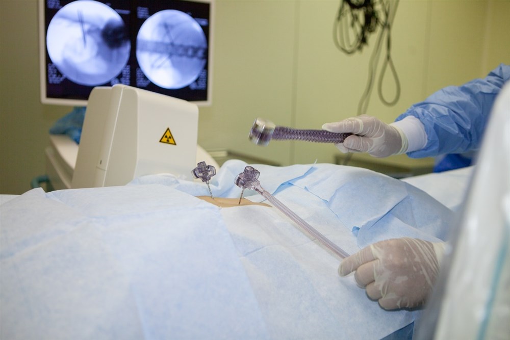 Аппарат используется в операциях на позвоночнике, предполагающих установку различного рода имплантатов. Это могут быть рентген-позитивные вещества, такие как костный цемент, используемый в процедуре вертебропластики, либо металлические конструкции, например, системы стабилизации позвонков.