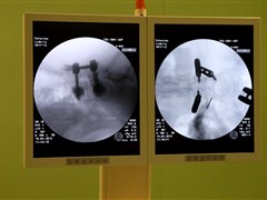 Проверка установки системы Viper Evolution. На снимке слева видно, как костный цемент заполнил тело позвонка.