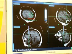 В операции используется нейрохирургическая навигация, позволяющая очень точно с минимальной травматизацией тканей достичь объекта исследования