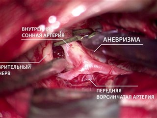 Гигантская аневризма головного мозга: операция, интервью с нейрохирургом Царикаевым А.В.