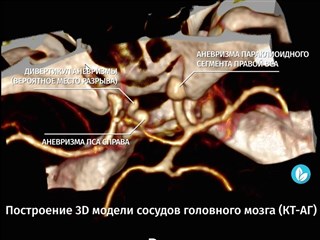 Клипирование аневризмы после разрыва. Нейрохирург Царикаев А.В.
